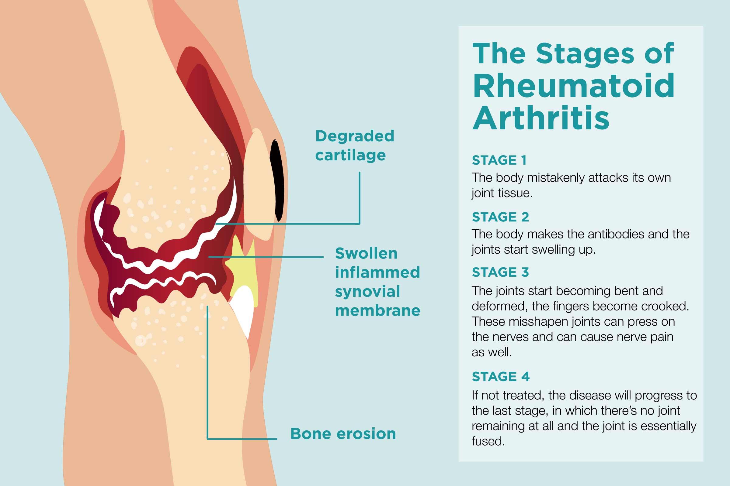 Understanding Rheumatoid Arthritis and ⁣Its Impact on⁢ Joint health