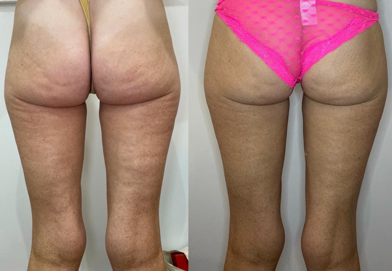 Exploring the Science Behind Cellulite and Skin Firming