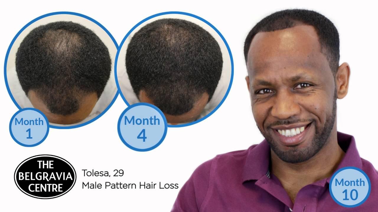 understanding Hair Loss in Men ​and the ⁢Role of Supplements