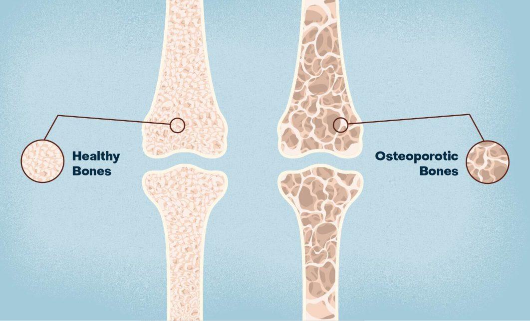 Key Nutrients for ‌Strengthening Bones after Menopause